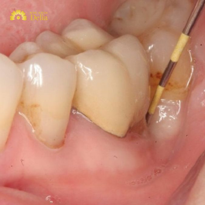 Hình ảnh chân răng hàm với mảng bám