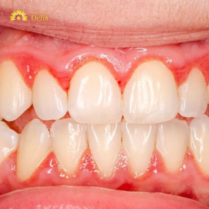 Hình ảnh nướu sưng đỏ khi xảy ra viêm chân răng