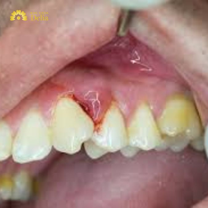 Hình ảnh sưng chân răng