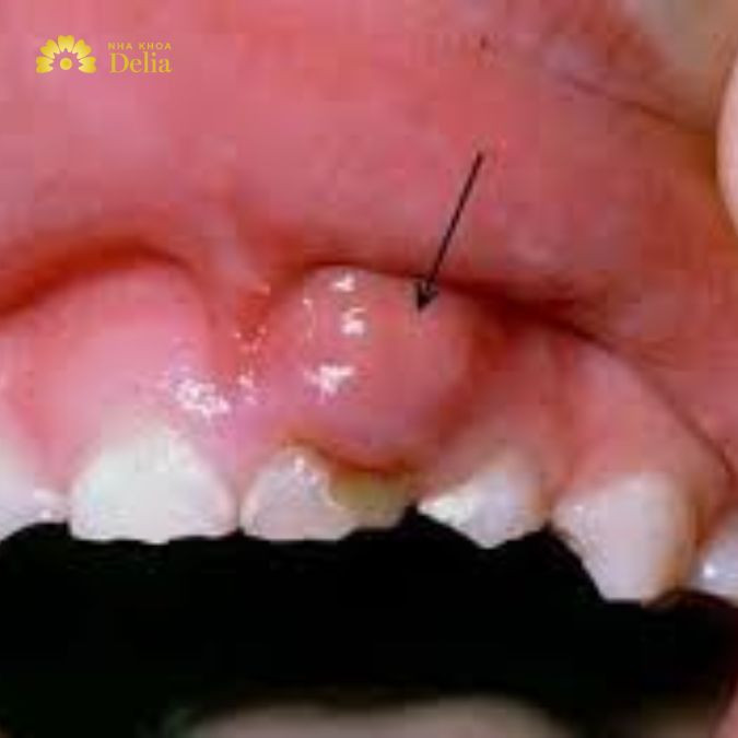 Dấu hiệu nhận biết viêm chân răng