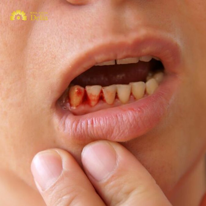 Hình ảnh về chảy máu chân răng khi viêm nhiễm xảy ra