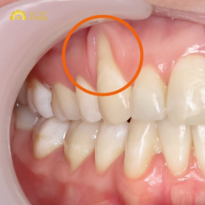 Hình ảnh hở chân răng khi viêm nhiễm nặng