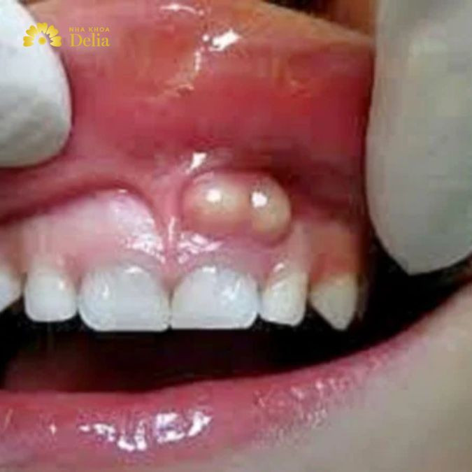 Hình ảnh túi mủ hình thành khi viêm chân răng
