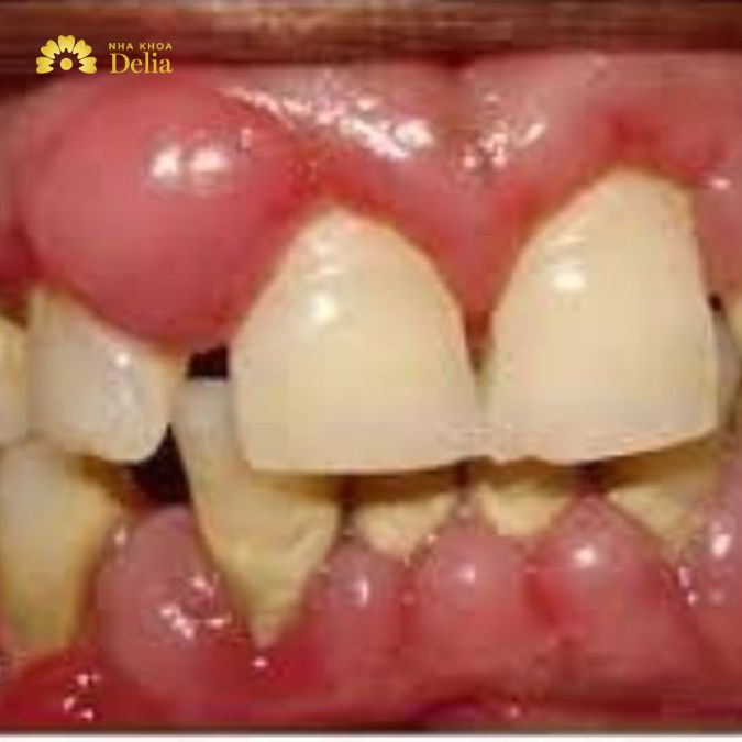 Hình ảnh mòn cổ chân răng