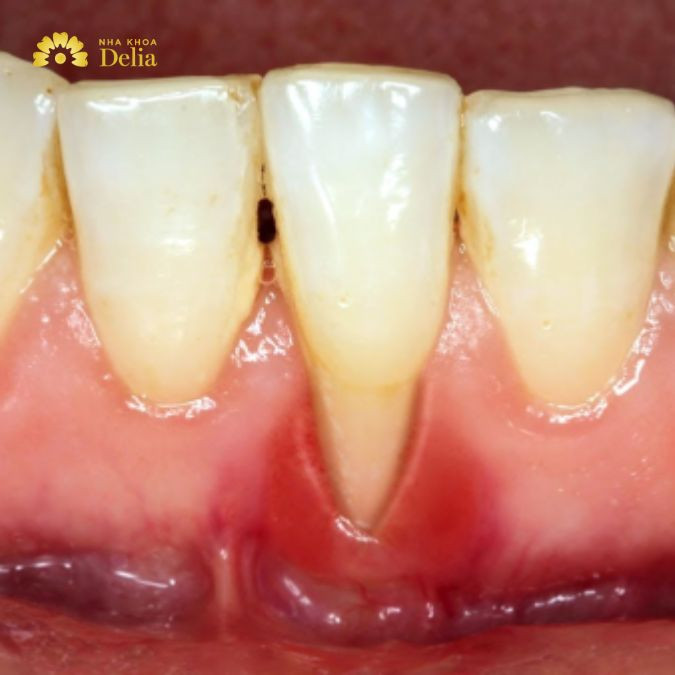 Hình ảnh viêm chân răng bị tụt lợi