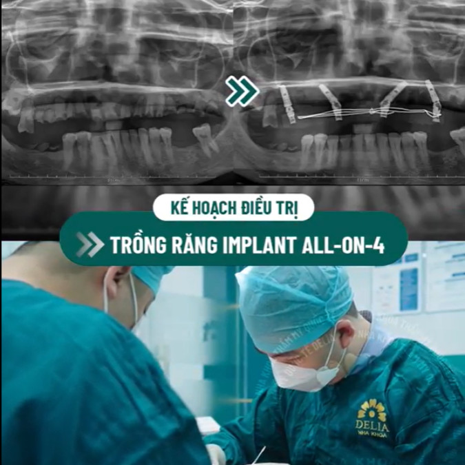Bác sĩ Việt lên kế hoạch trồng răng Implant all on 4 cho trường hợp của chị Quế