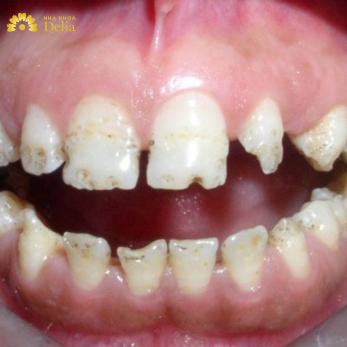 Vệ sinh răng miệng không sạch sẽ cũng là nguyên nhân khiến cho mảng bám thức ăn hình thành, tạo điều kiện cho vi khuẩn sinh sôi