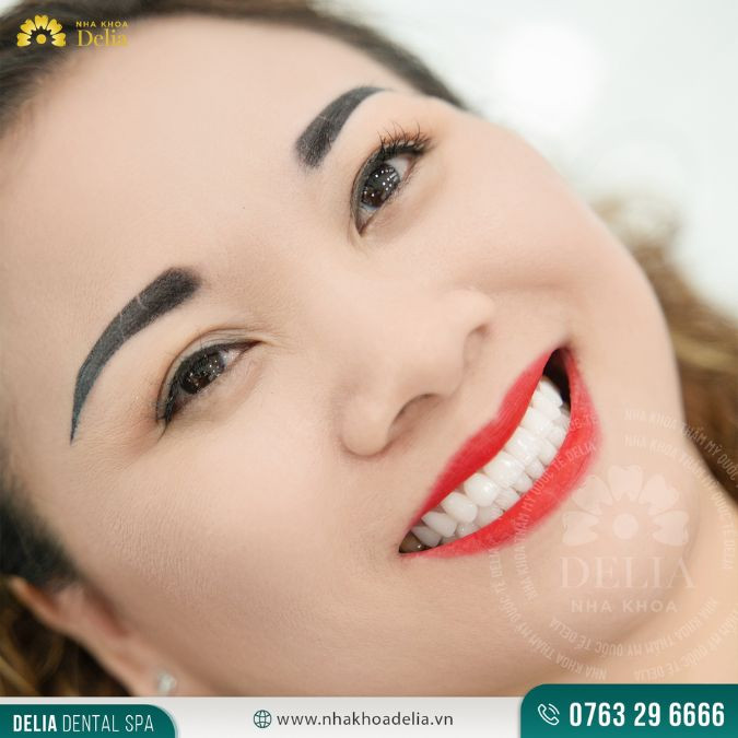 Dán sứ Veneer