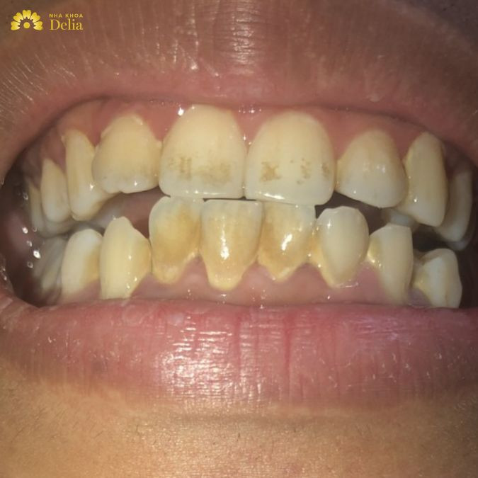 Men răng cũng sẽ bị ảnh hưởng nếu như bạn gặp các vấn đề như lộ ngà răng, nứt men răng