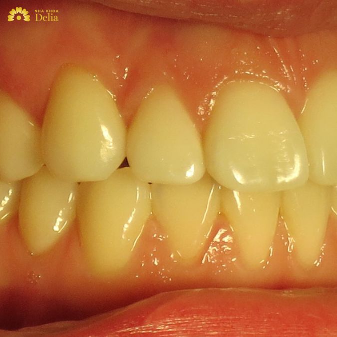 Men răng vàng là bệnh gì? Cách khắc phục hiệu quả ra sao?