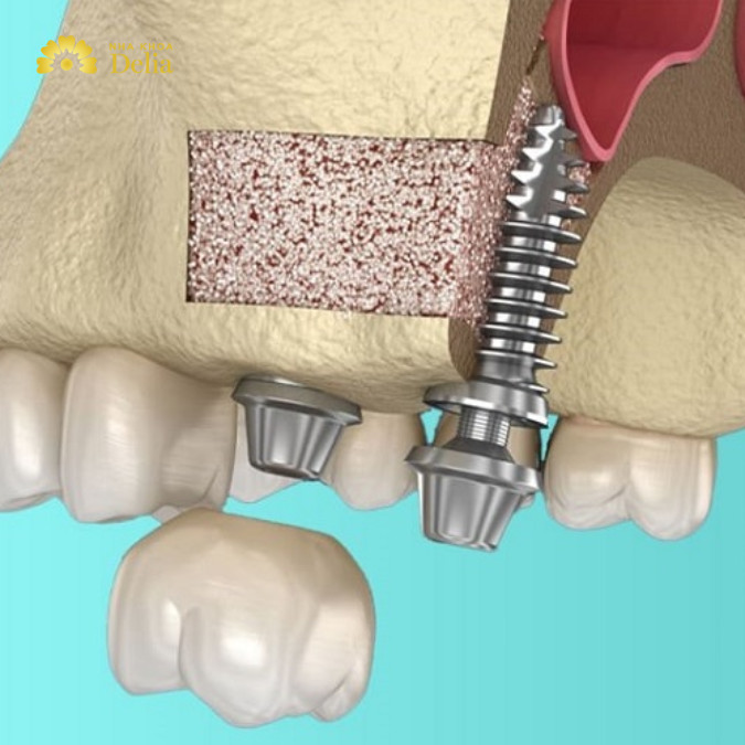 Nâng xoang kín giúp giảm xâm lấn, hạn chế đau nhức, biến chứng