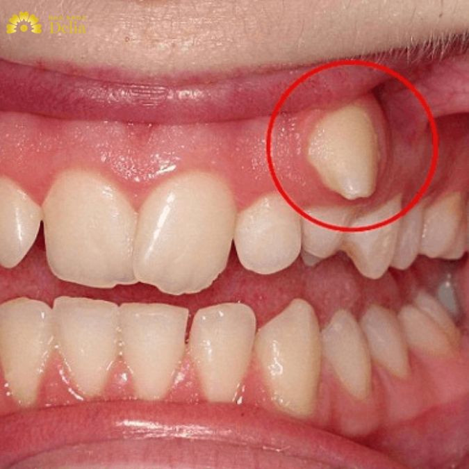 Răng khểnh nên nhổ hay không sẽ còn tùy trường hợp