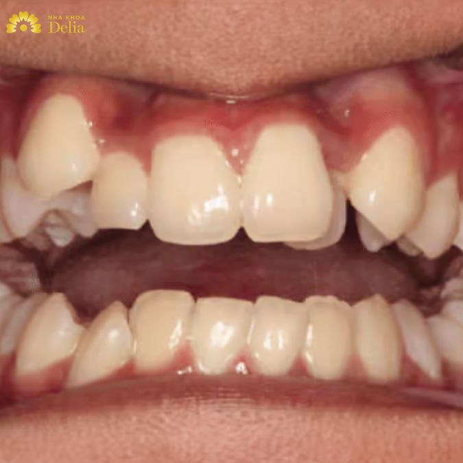 Răng khểnh mọc lệch