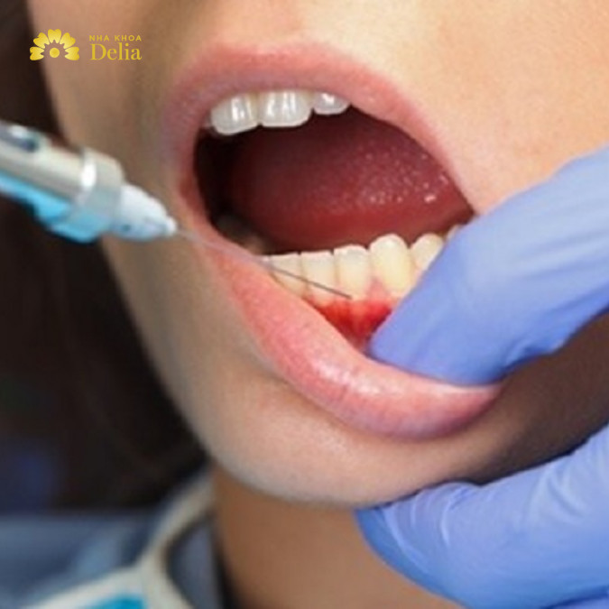 Trước khi nhổ răng sâu bạn được bác sĩ gây tê để không đau đớn trong suốt quá trình nhổ