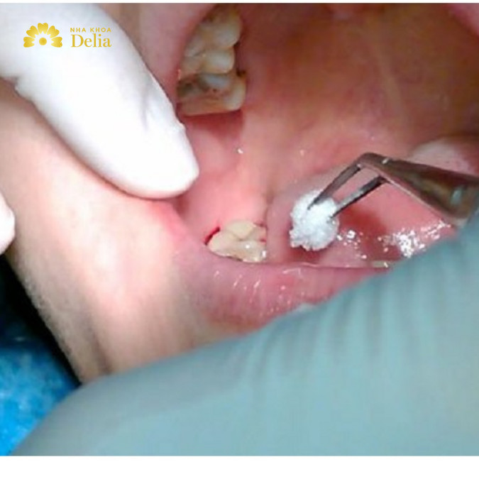 Sau khi nhổ răng bạn nên cắn bông gòn ở vị trí nhổ và có thể uống thuốc giảm đau nếu cảm thấy khó chịu