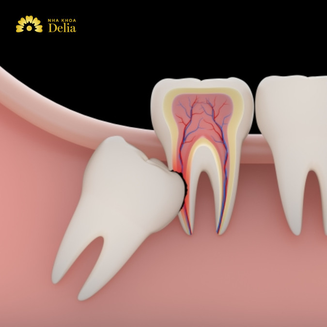 Các yếu tố ảnh hưởng đến giá nhổ răng sâu hàm dưới: loại răng sâu cần nhổ