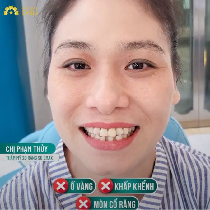 Chị Phạm Thủy đối diện với tình trạng răng ố vàng, khấp khểnh, mòn cổ răng