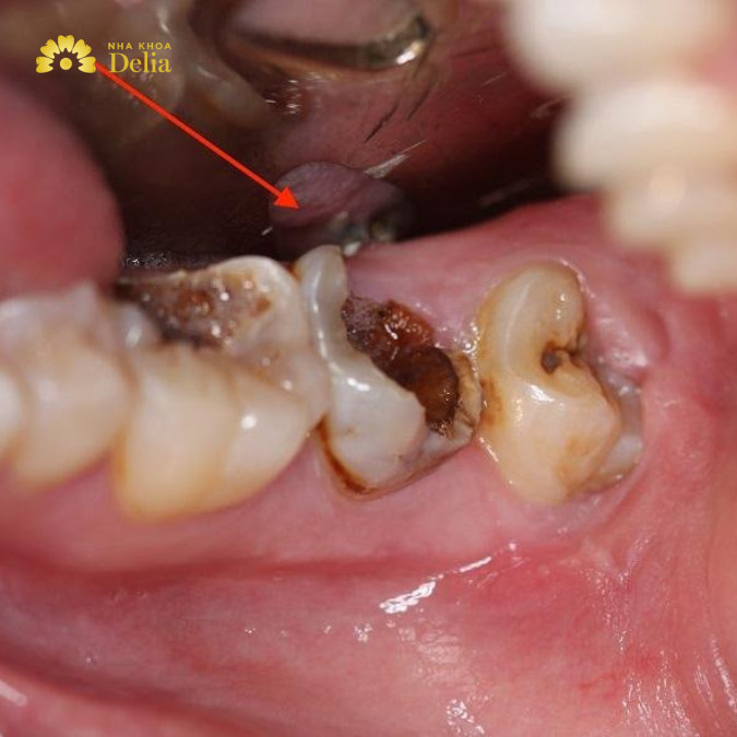 Răng bị sâu vỡ có nên nhổ không? Giải mã các hiểm họa tiềm ẩn