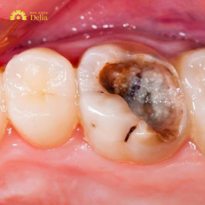 Răng vỡ nặng, phá hủy phần lớn cấu trúc răng, không có khả năng phục hình sẽ cần nhổ