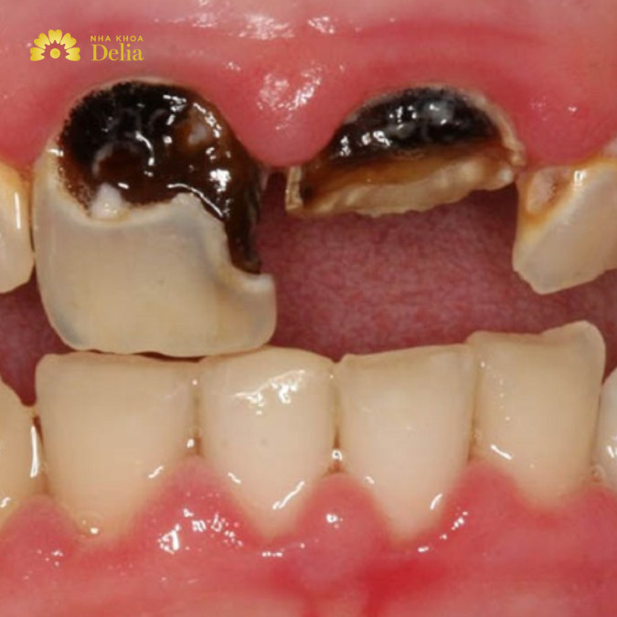 Cần nhổ răng khi răng sâu vỡ ảnh hưởng và có xu hướng lan rộng sang các răng khác
