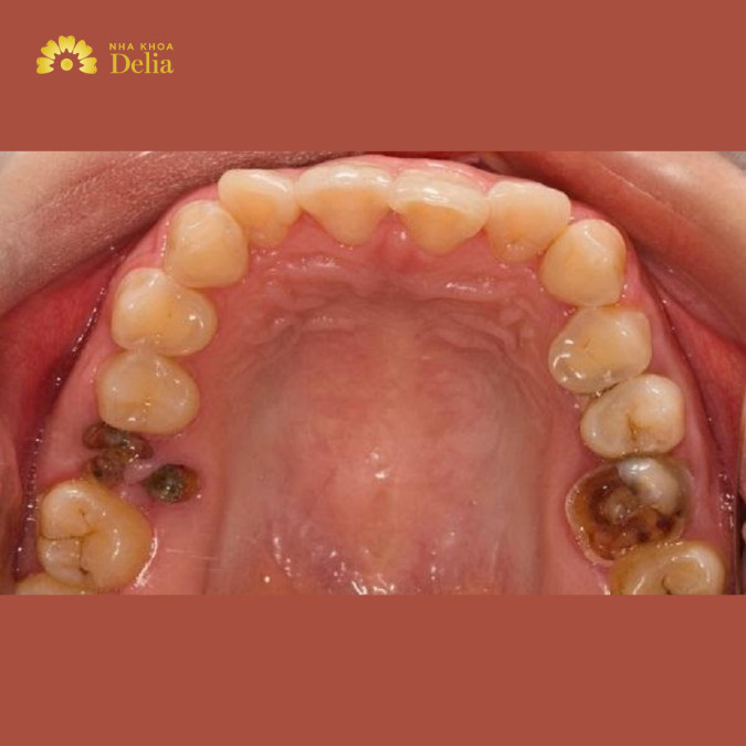 Nguy cơ nhiễm trùng cao khi không điều trị răng sâu vỡ