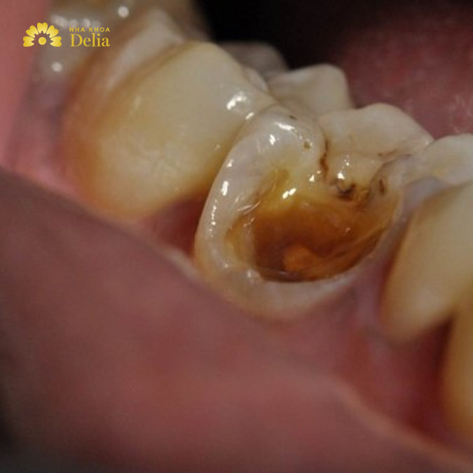 Các cơn đau có tần suất và mức độ cao hơn khi răng không được điều trị kịp thời