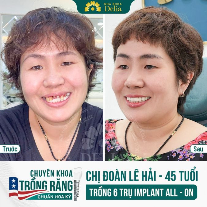 Trồng răng Implant