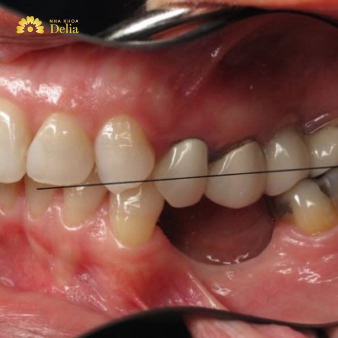 Điều trị răng lung lay cấp độ 2 như thế nào: nẹp cố định răng