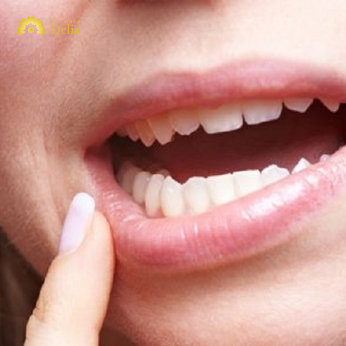 Răng lung lay độ 2 là như thế nào?