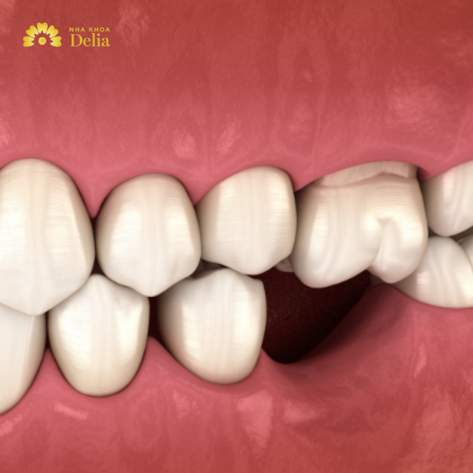 Răng lung lay độ 2 có nguy hiểm không? 