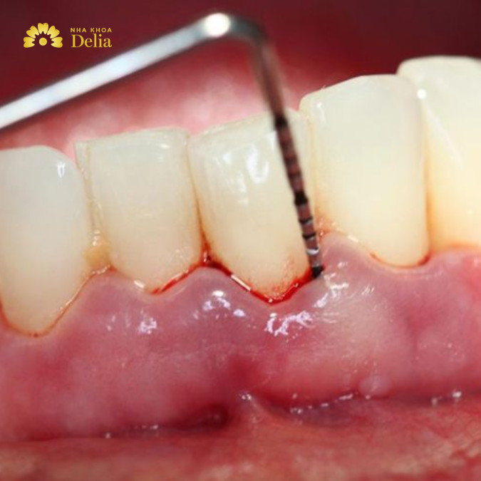 Nguyên nhân khiến răng lung lay: các vấn đề về nướu