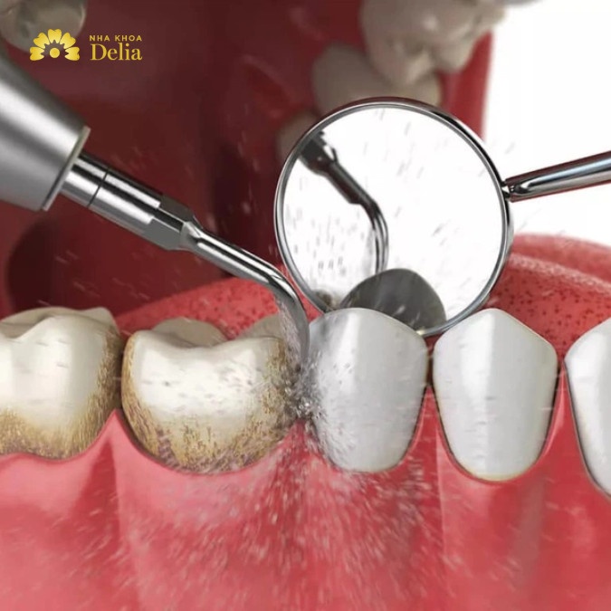 Viêm nha chu mức độ nhẹ cần lamd sạch chuyên sâu bằng cách lấy cao răng