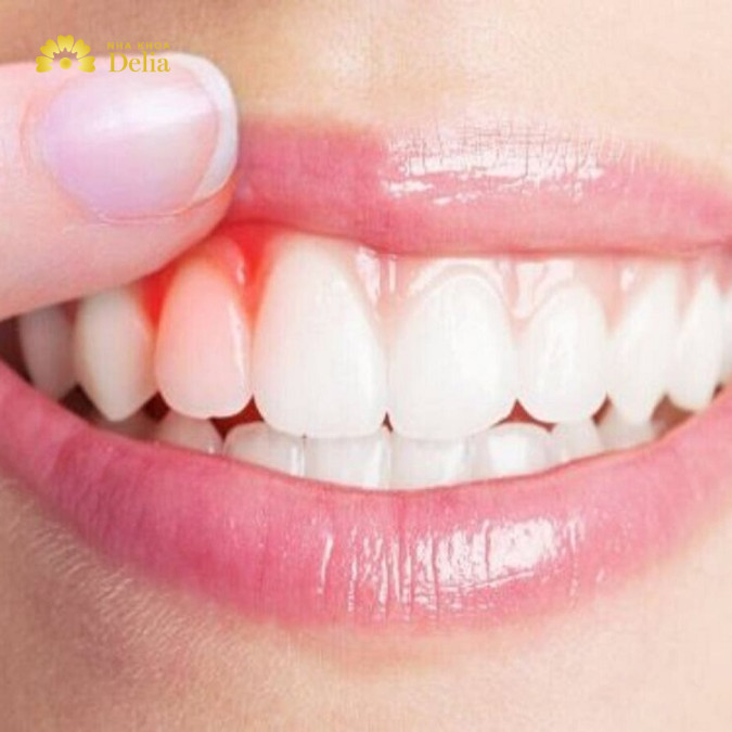 Răng lung lay sưng lợi nguyên nhân do đâu: bệnh lý nha chu