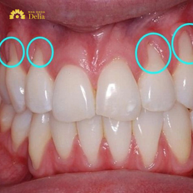 Viêm nướu khiến lợi sưng đỏ, răng không chắc chắn như trước