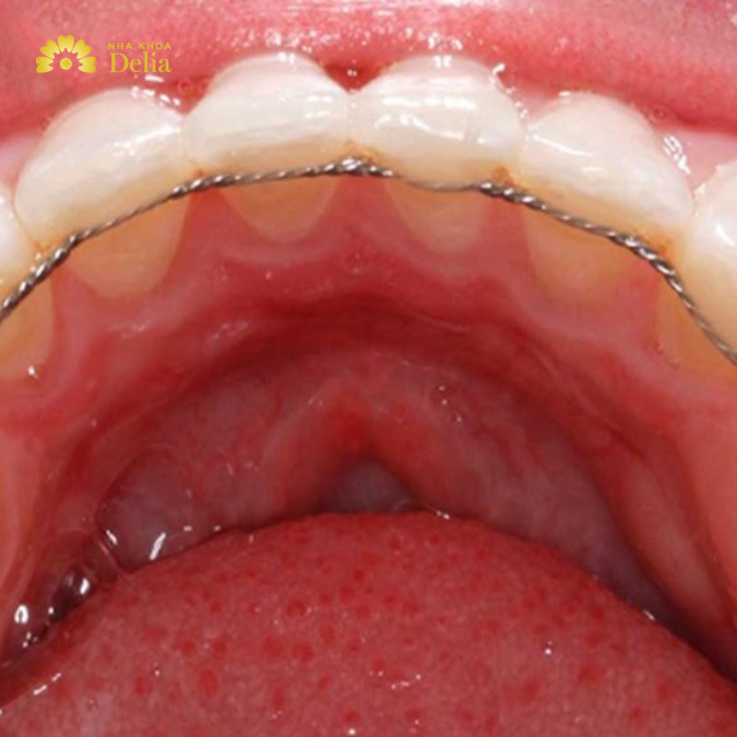 Răng lung lay nặng cần nẹp răng để răng ổn định dần