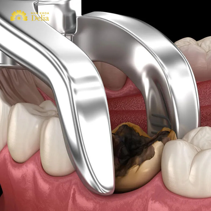 Răng sâu đang đau có nhổ được không, cần phải xem xét mức độ sưng đau của răng