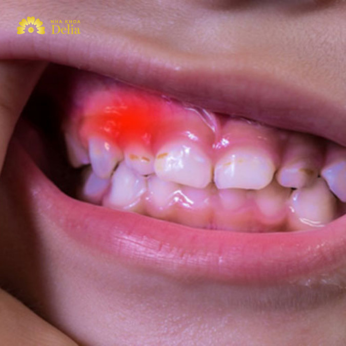 Răng sâu đang đau trường hợp nào không nhổ được: răng sưng đau mức độ nặng, thậm chí phát sốt