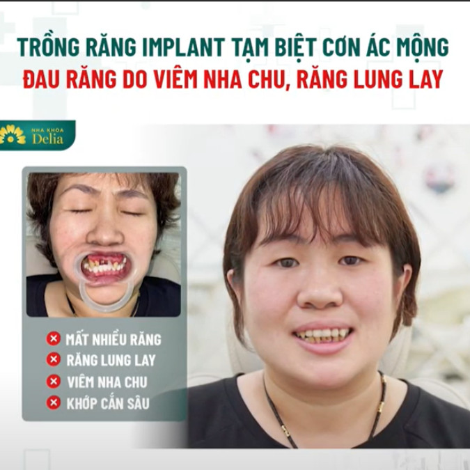 Tình trạng của chị Hải khi đến với Delia: mất nhiều răng, viêm nha chu, răng lung lay, khớp cắn sâu