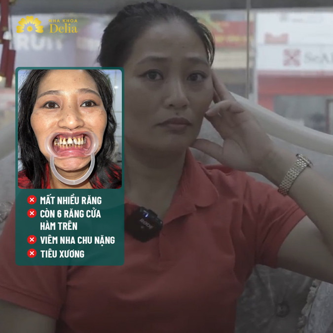 Chị Thanh bị sụt gần 20 kg vì mất răng trong 10 năm với tình trạng mất răng phức tạp