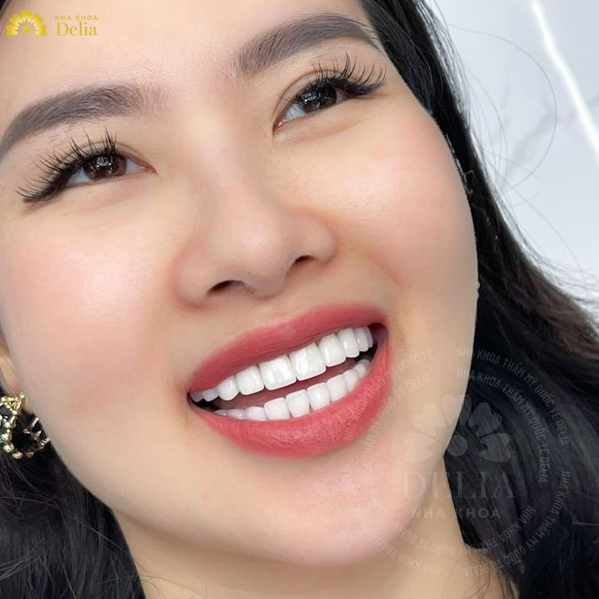 Men răng cũ đã được thay thế bằng men răng nhân tạo, trở thành lớp bảo vệ ngăn ngừa tác nhân gây hại
