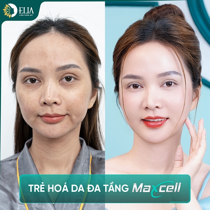 Maxcell là phương pháp làm đẹp định hình khuôn mặt toàn diện