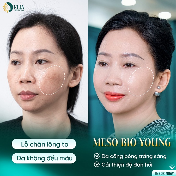 Trẻ hoá tế bào Meso Bio Young: