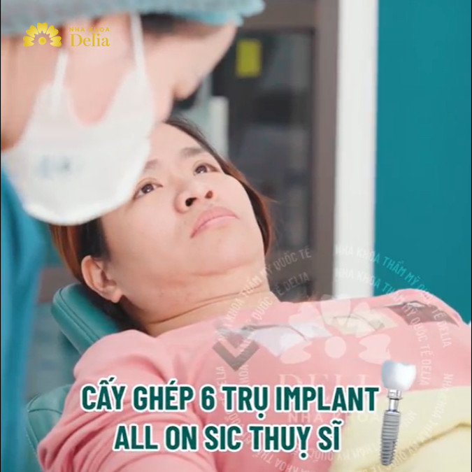 Phác đồ điều trị của bác sĩ Việt là cấy ghép 6 trụ Implant all on SIC Thụy Sĩ