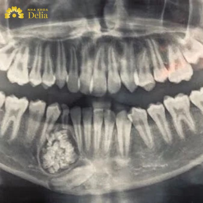 U men răng là một khối u lành tính nhưng có thể phát triển âm thầm và xâm lấn liên tục