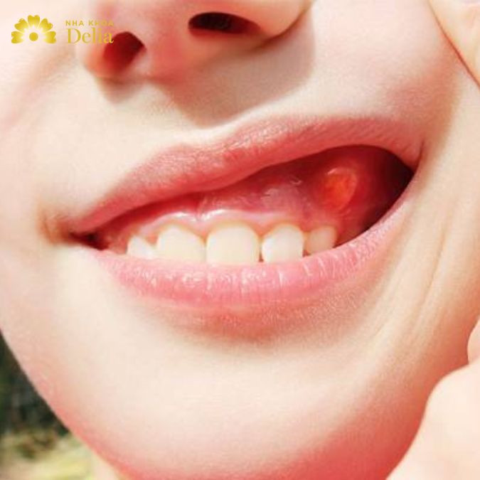Nếu việc cắt bỏ u liên quan đến việc loại bỏ một phần xương hàm, bác sĩ có thể tiến hành phẫu thuật khác để sửa chữa và tái tạo lại hàm
