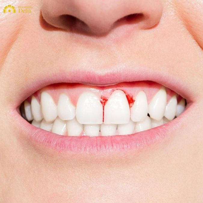 Người bệnh tiểu đường có lượng đường trong máu cao, tạo môi trường thuận lợi cho vi khuẩn phát triển, dẫn đến viêm nướu nặng hơn so với người bình thường