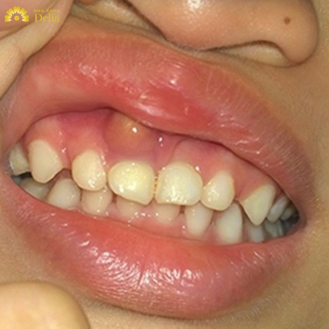 Không chỉ làm tổn thương tại chỗ, viêm lợi có mủ còn khiến cho những cơ quan lân cận bị ảnh hưởng