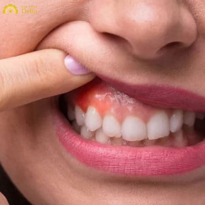 Ăn nhiều đồ ăn thức uống quá lạnh, quá nóng hay thực phẩm nhiều gia vị khiến cho vùng nướu dễ bị lở loét, sưng tấy kèm theo đau nhức