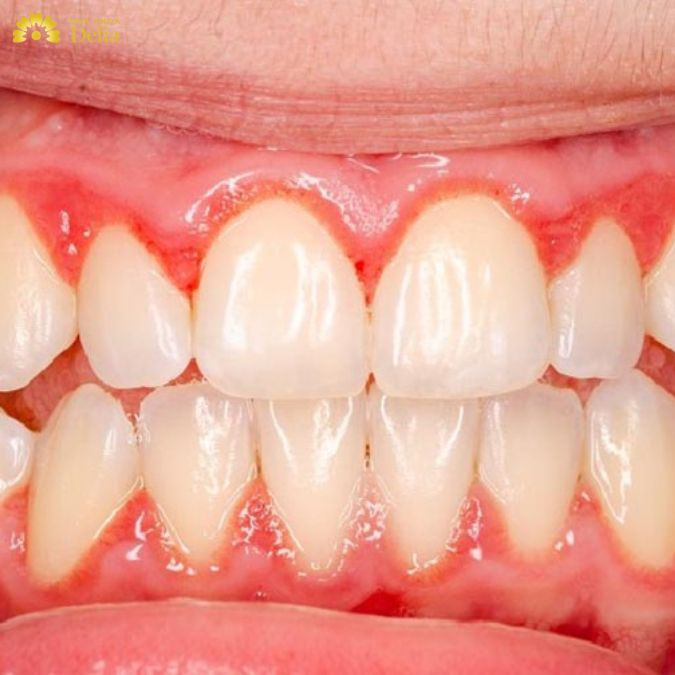 Viêm lợi phì đại là một tình trạng nha khoa nghiêm trọng, phát triển từ giai đoạn viêm lợi