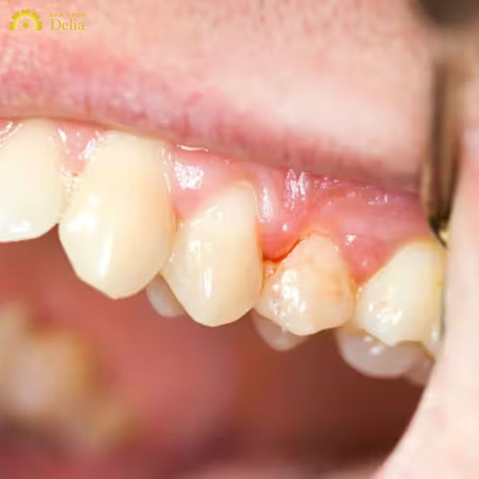 sự tấn công dai dẳng của vi khuẩn này là nguyên nhân chính dẫn đến tình trạng viêm nhiễm, sưng đỏ